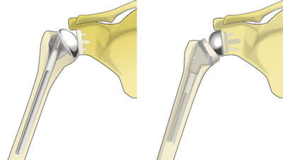 人工肩関節置換術とリバース型人工肩関節置換術
