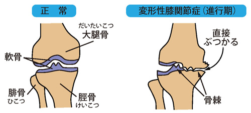 正常な膝と変形性膝関節症（進行期）