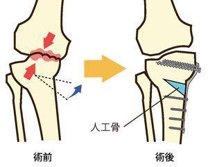 高位脛骨骨切り術