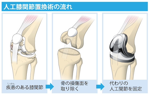 人工膝関節置換術の流れ