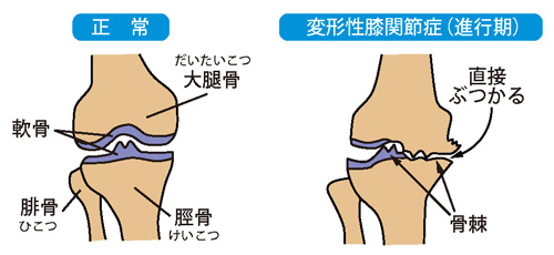 正常な膝と変形性膝関節症（進行期）