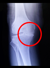 竹内 尚人 先生 北岡 克彦 先生 高齢者に多い変形性膝関節症 人工関節置換術で痛みのない生活を 若者からお年寄りまで 膝痛の原因と対処法 人工関節ドットコム