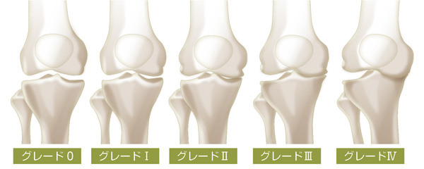 変形性膝関節症のKL分類