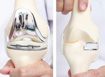 人工膝関節（全置換と部分置換）の一例