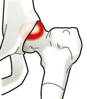 大腿骨寛骨臼インピンジメント症候群