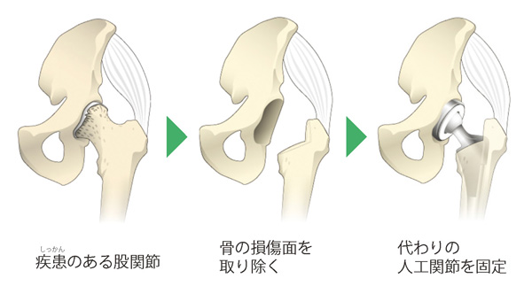 人工股関節置換術