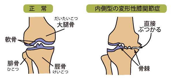 正常な膝と内側型の変形性膝関節症