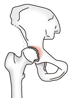 変形性股関節症