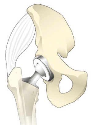 人工股関節置換術