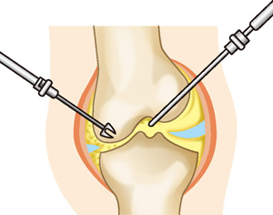 関節鏡手術