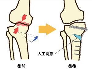 骨切り術