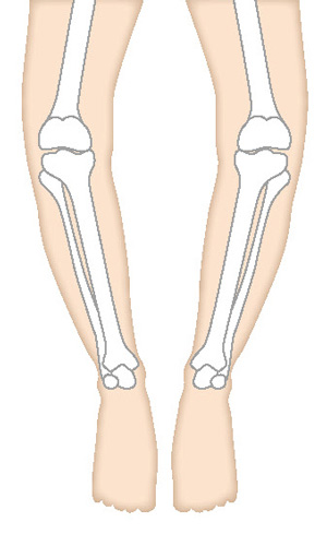 O脚変形