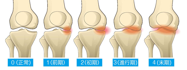 変形性膝関節症の5段階