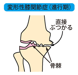変形性膝関節症（進行期）