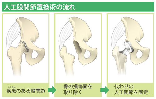 人工股関節置換術の流れ