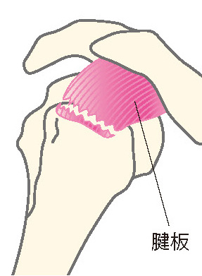 腱板断裂（けんばんだんれつ）