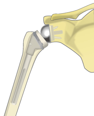 リバース型人工肩関節全置換術
