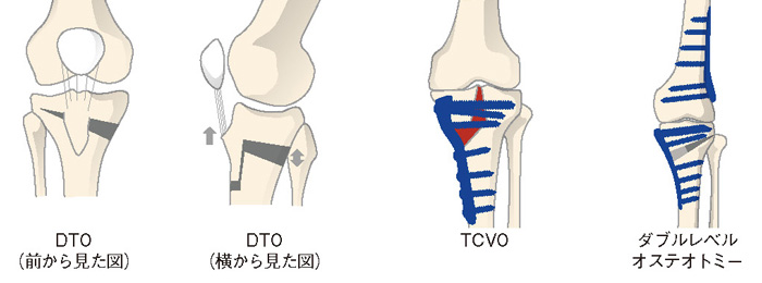 DTO／TCVO／ダブルレベルオステオトミー