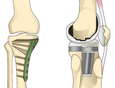 骨切り術と人工膝関節置換術