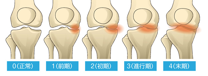 変形性膝関節症の5段階