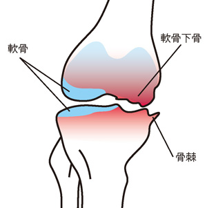 変形性膝関節症