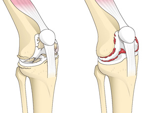 変形性膝関節症と関節リウマチ