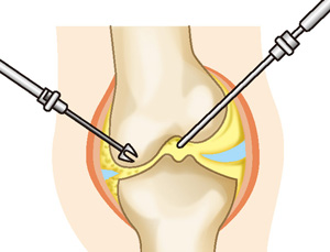関節鏡視下手術