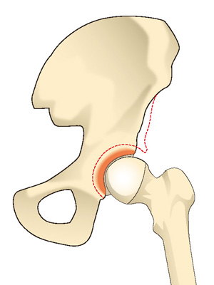 日本に多い二次性変形性股関節症