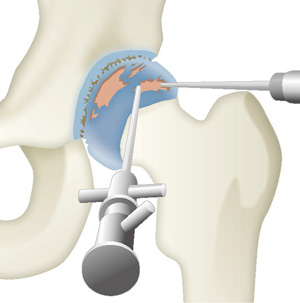 股関節鏡手術