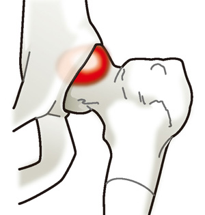 大腿骨寛骨臼インピンジメント
