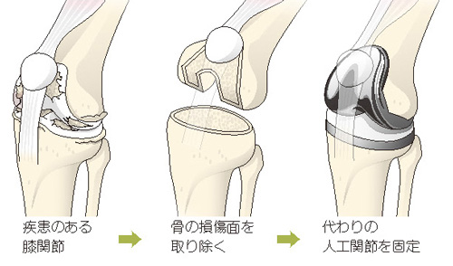 人工膝関節全置換術の流れ