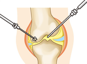 関節鏡視下手術