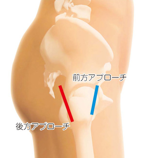 人工膝関節全置換術の流れ