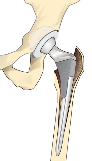 人工股関節置換術