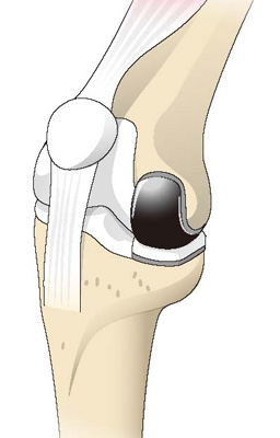 人工膝関節単顆置換術