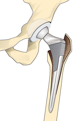 人工股関節全置換術