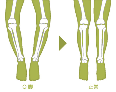 O脚がひどかった脚の変形を改善します