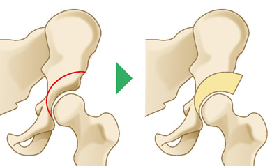 寛骨臼回転骨切り術