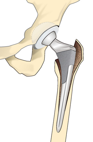 人工股関節置換術