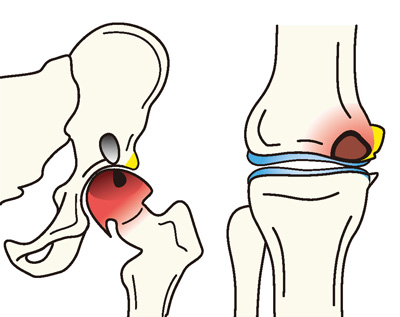 大腿骨頭壊死症（左）と大腿骨内顆骨壊死（右）