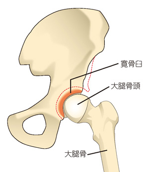 寛骨臼形成不全