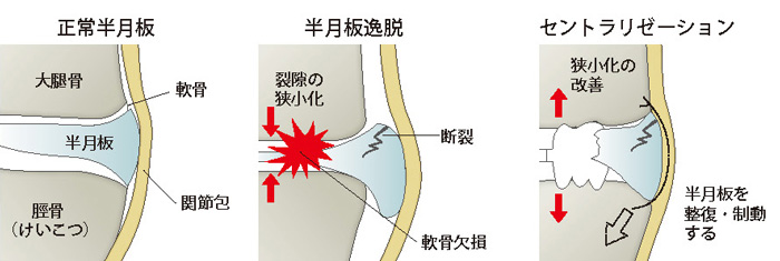 正常半月板、半月板逸脱、セントラリゼーション