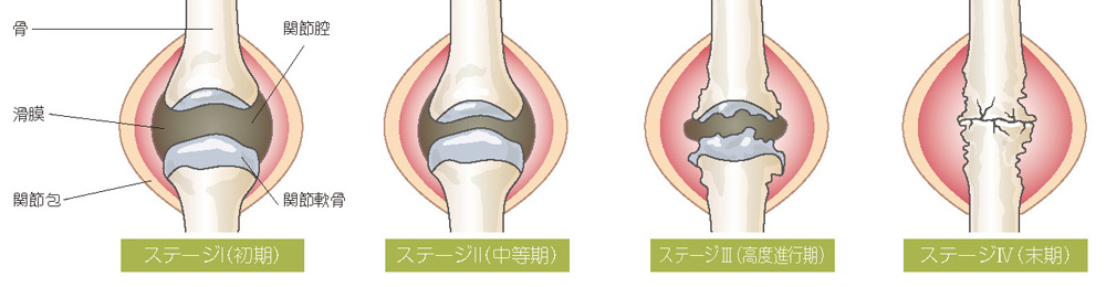 関節破壊の進行度