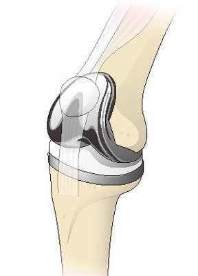 人工関節全置換術