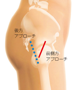 前側方アプローチと後方アプローチ