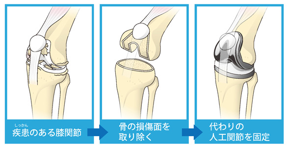 全置換術の流れ