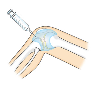 ヒアルロン酸注射