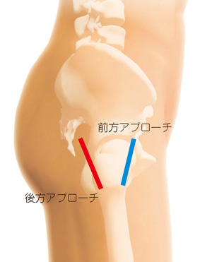 前方アプローチと後方アプローチ