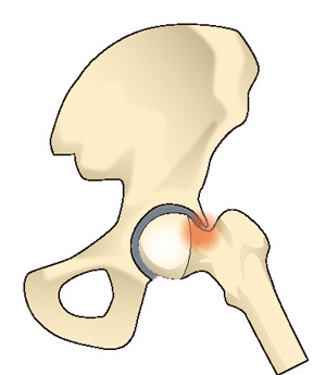 大腿骨寛骨臼インピンジメント（FAI）