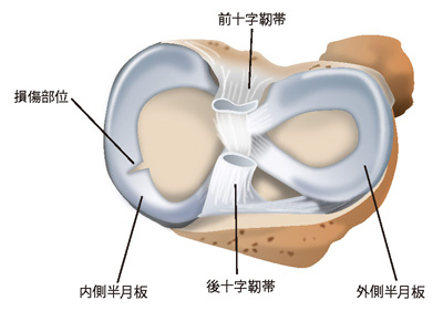 内側半月板後角損傷